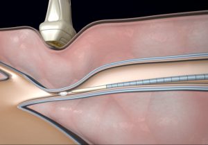 Krampfadern behandeln mit VenaSeal | © Medtronic